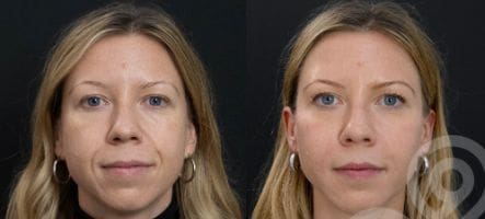 Full Face Transformation